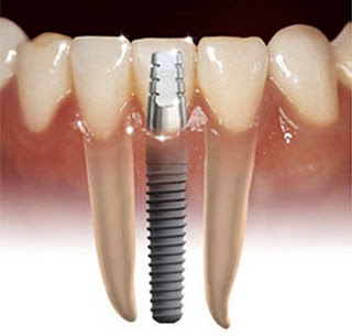 Implantes Dentales