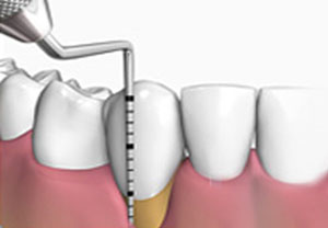 Periodoncia